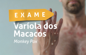 Hemopac disponibiliza exame que detecta varíola do macaco (Monkeypox)